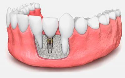 Regeneración ósea avanzada ¿En qué consiste?